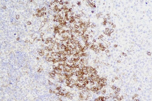 IHC of CD123 on an FFPE Kikuchi-Fujimoto Disease Tissue